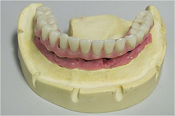 An image of a dental mold with upper and lower teeth, showcasing a set of dentures with pink gums.