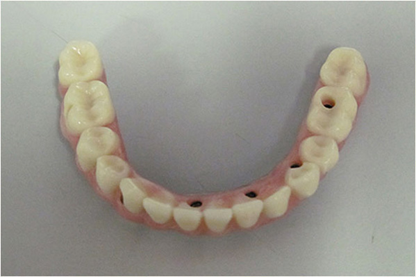 The image displays a set of human teeth with visible enamel wear and holes for dental implants, placed on a flat surface against a neutral background.