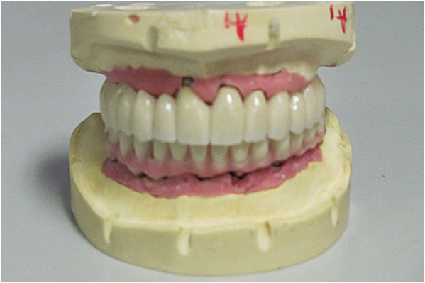 An image of an artificial human upper denture with visible pink gum-like material and a single tooth displayed against a white background.
