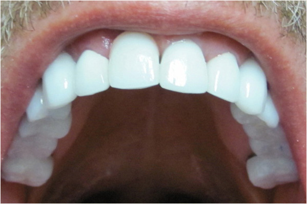 The image shows a close-up of an open mouth with white teeth, displaying the interior of the oral cavity with visible tongue and palate.