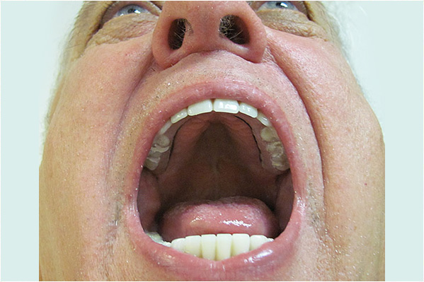 The image shows an elderly man with his mouth wide open, displaying his teeth and tongue, which are in close-up view.