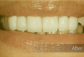 The image shows a close-up view of a person's teeth with a focus on cosmetic dental work, likely a before-and-after comparison for a smile enhancement service.