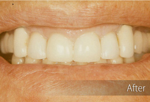 The image shows a person's teeth after dental treatment, with an 'after' label indicating a transformation.