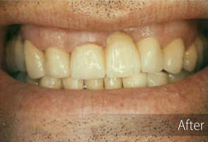 The image shows a close-up of a person's mouth with a wide smile, revealing yellowed teeth and gums, after dental treatment, which includes a whiter appearance of the teeth.