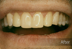 The image shows a close-up of a person's mouth with visible dental work, specifically teeth whitening, which has been completed, indicated by the contrast between the treated and untreated teeth.