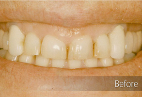 The image shows a close-up of a person's teeth with a focus on cosmetic dental work, specifically a smile makeover.
