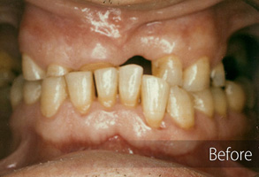 The image shows a close-up of a person's mouth with teeth before and after dental work, indicating a transformation from yellowed and damaged teeth to cleaner and repaired teeth.