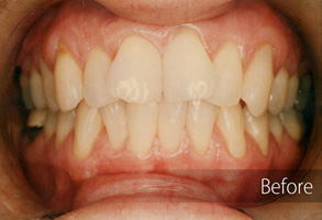 The image shows a close-up view of an open mouth with teeth that have been straightened or aligned, indicating dental orthodontic treatment.