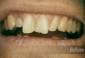 The image shows a close-up of a person's mouth with teeth before and after dental treatment, indicating an improvement in oral health.