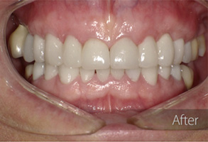 The image shows a person's mouth with teeth that appear to be significantly altered through cosmetic dental work, likely involving veneers or crowns, accompanied by a caption or overlay text that suggests before-and-after transformation.