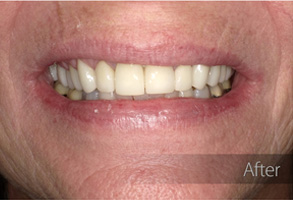 The image shows a close-up of an older person's face with a smile, displaying dental work such as veneers or teeth whitening.
