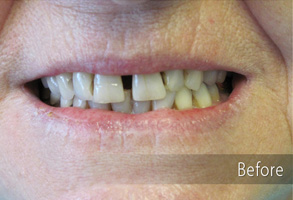 The image shows a close-up of an elderly person's face with a smile, focusing on their teeth which have been restored with dental implants or veneers, indicating a transformation through cosmetic dentistry.