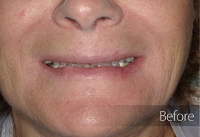 A close-up photograph of a woman's face showing her smiling, with noticeable cosmetic dental work evident.