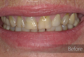 The image shows a person's smile after undergoing teeth whitening treatment, with visible improvement in the shade of their teeth.
