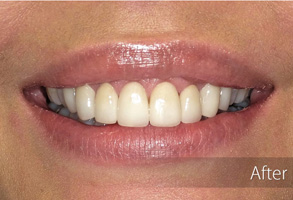 The image displays a close-up view of a person's smiling face with teeth, showing a before-and-after comparison likely related to dental care or cosmetic procedures.