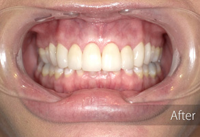 The image shows a person with an open mouth, displaying teeth, undergoing dental treatment, likely a cleaning or whitening process, with visible cleaning tools inside their mouth.
