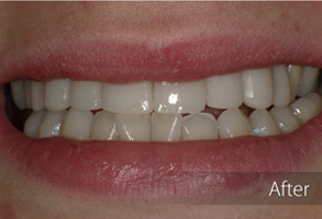 The image shows a close-up view of a smiling person with white teeth, likely after a dental procedure such as teeth whitening or orthodontic treatment, indicated by the text 'after.