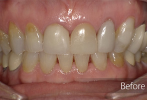 Before and after comparison of teeth whitening treatment.
