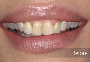 The image shows a person with a wide smile displaying white teeth after dental treatment.