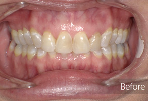 The image shows a person's mouth with their teeth, featuring an upper set of yellowed teeth and lower set of white teeth, with a visible dental implant on the right side. There are also visible braces and a gumline that appears to be in the process of being treated or maintained.