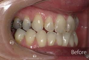 The image displays a close-up view of an open mouth with teeth showing, set against a blurred background.