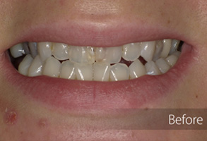 The image shows a close-up view of a person's teeth undergoing cosmetic dental treatment, with visible braces and a before-and-after comparison highlighting the transformation.